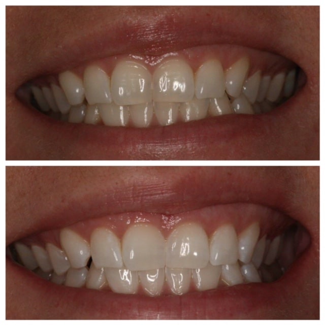 Zoom Teeth Whitening Before/ After | My Candlewood Dental Fairfield, CT 