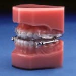 Teeth Model wearing a Mandibular advancement device and placed on a a blue table.