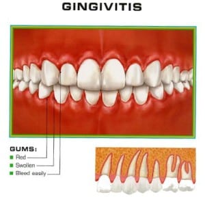 What is Gingivitis ?