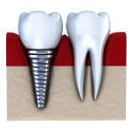 dental implants candlewood dental care new fairfield ct