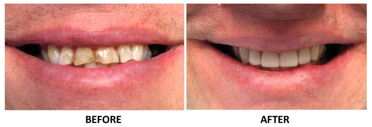 Before and After Image: Crowns - front