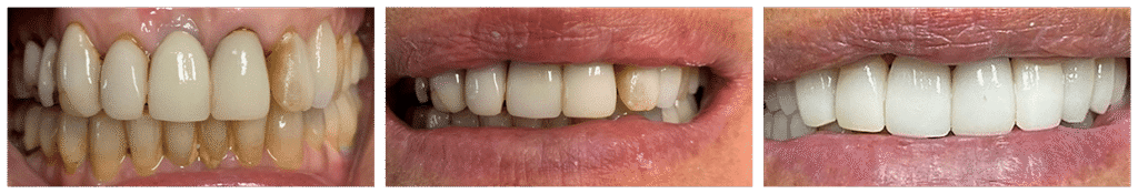 Before and After Image: Veneers - front