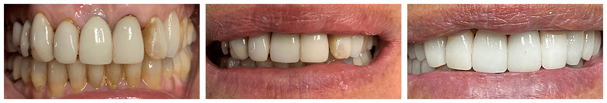 Before and After Image: Veneers - front