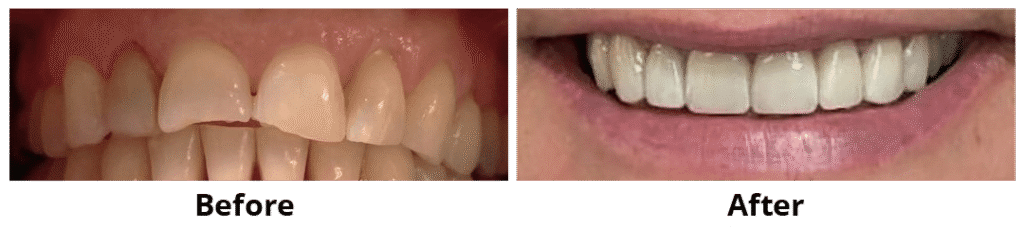 Before and After Image: Veneers - front