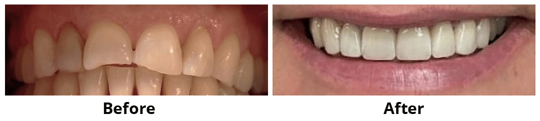 Before and After Image: Veneers - front