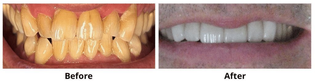 Before and After Image: Veneers - front