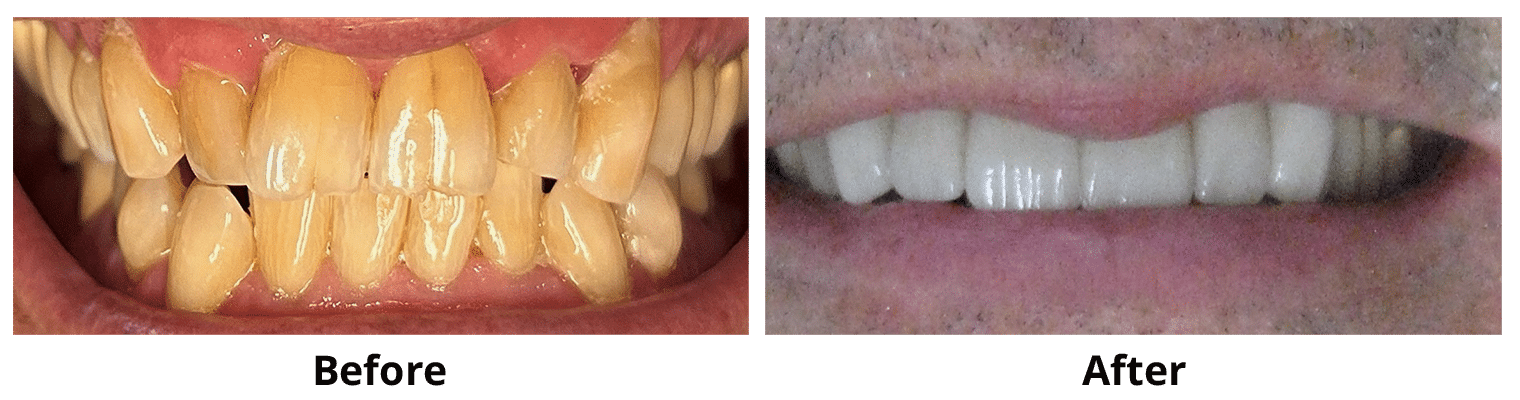 Before and After Image: Veneers - front