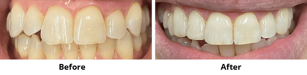 Before and After Image: Bonding - front