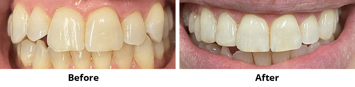 Before and After Image: Bonding - front