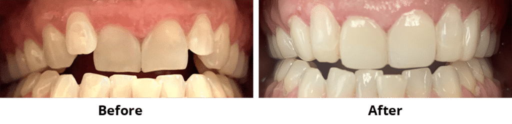Before and After Image: Bonding - front