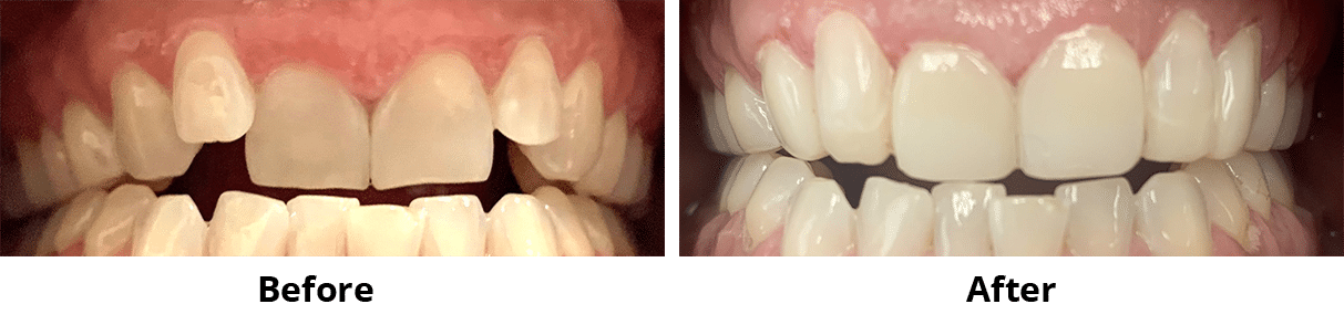 Before and After Image: Bonding - front