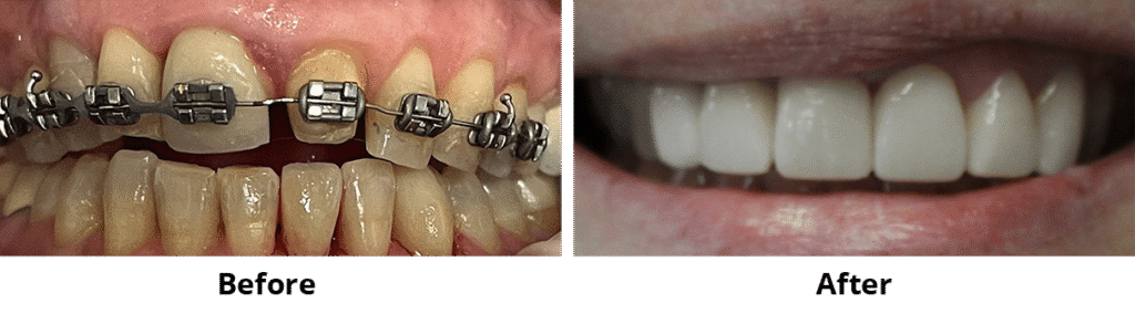 Before and After Image: Veneers - front