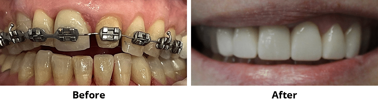 Before and After Image: Veneers - front