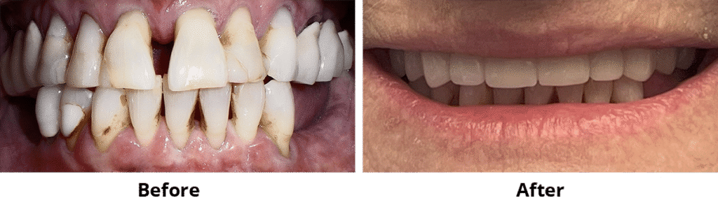 Before and After Image: All-on-4 - front