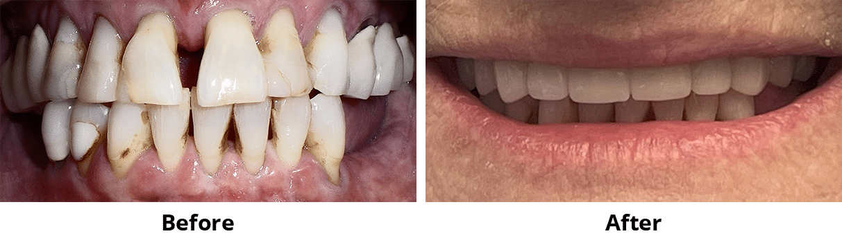 Before and After Image: Implant Bridge - front