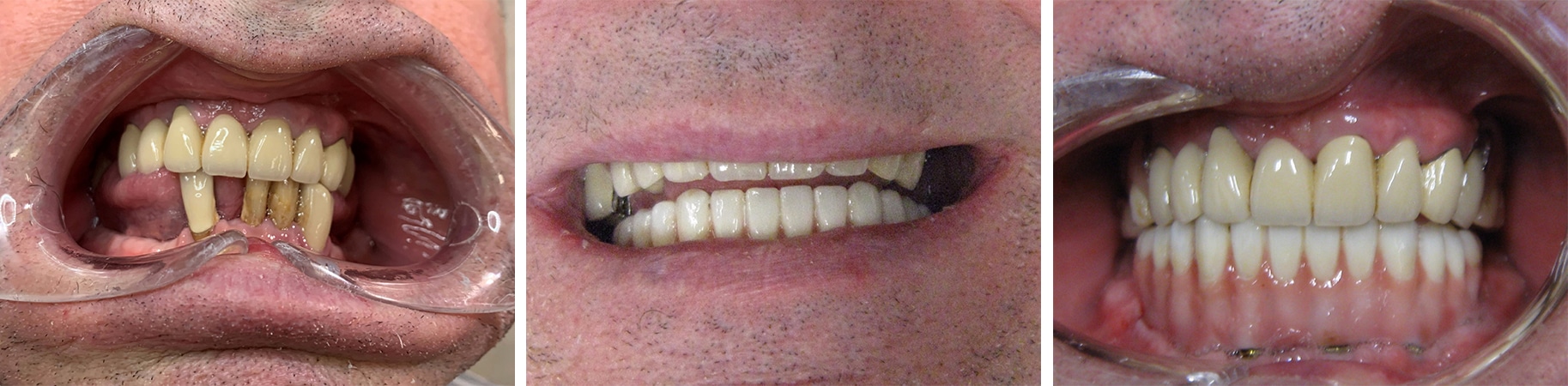 Before and After Image: All-on-4 - front