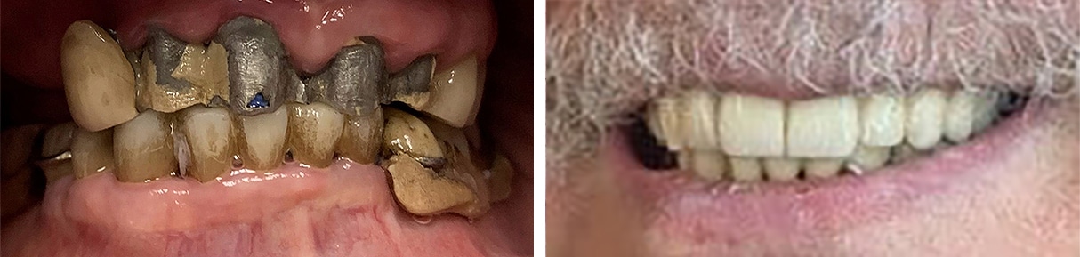 Before and After Image: All-on-4 - front