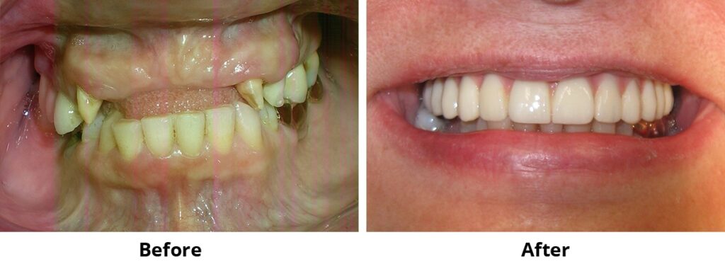 Before and After Image: All-on-4 - front