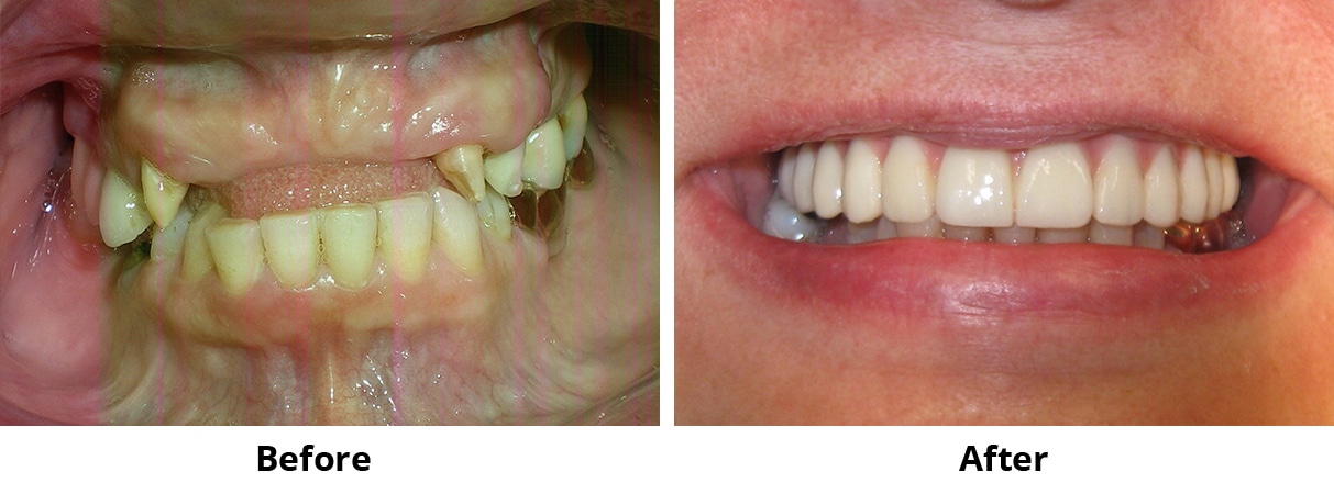 Before and After Image: All-on-4 - front