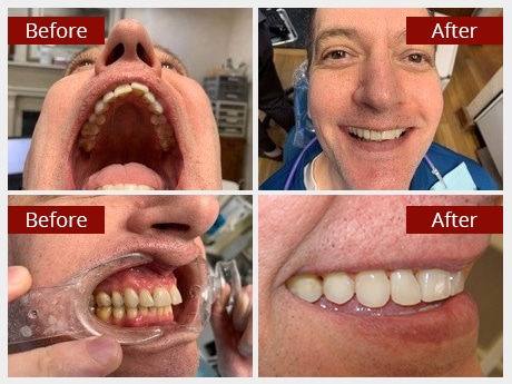 Before and After Image: SureSmile - other
