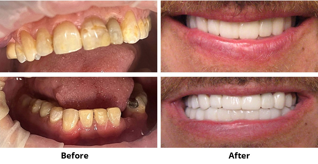 Before and After Image: Veneers and Snap On Smile - front