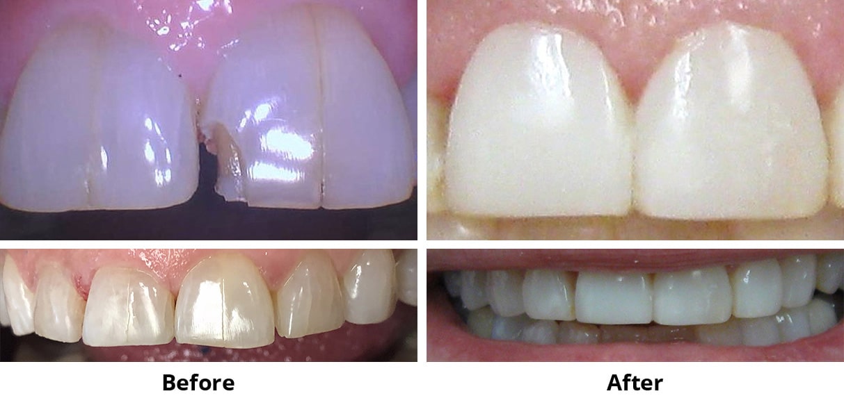 Before and After Image: Resin Veneers - front
