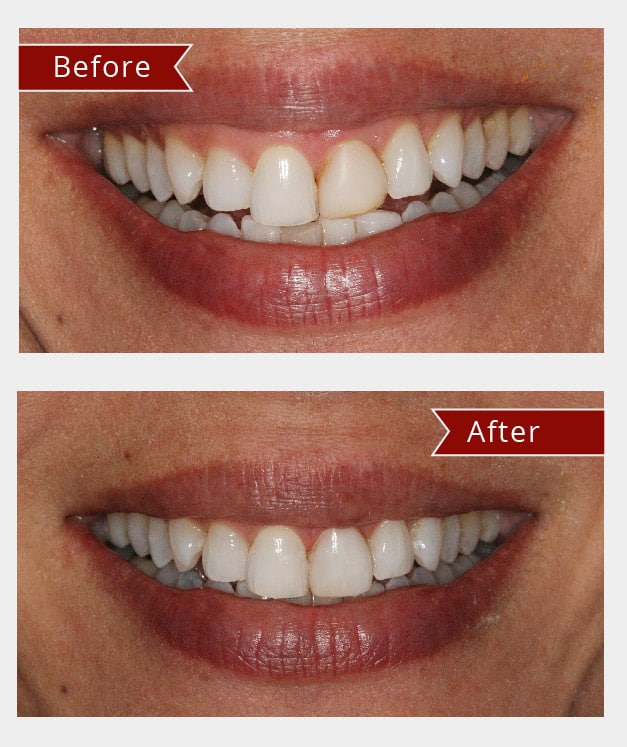 Before and After Image: Bonding - front