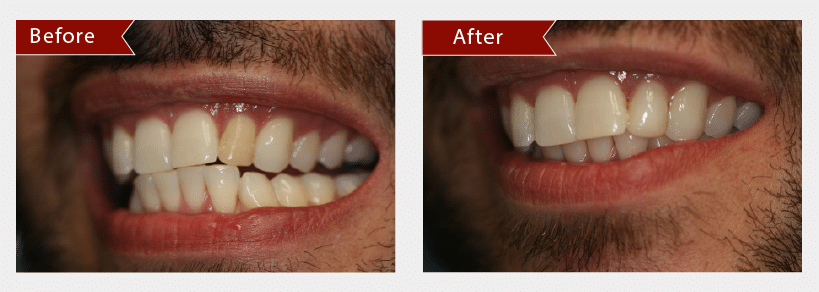 Before and After Image: Bonding - left-front-oblique