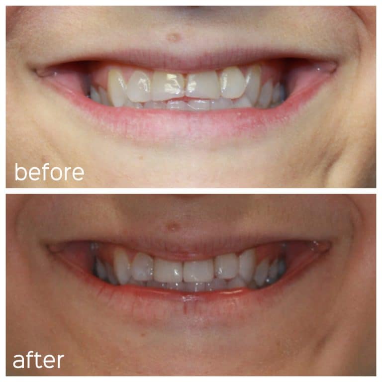 Before and After Image: Crowns - front