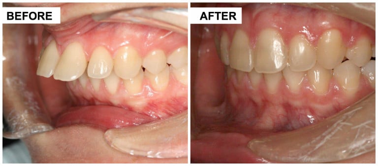 Before and After Image: SureSmile - left-front-oblique