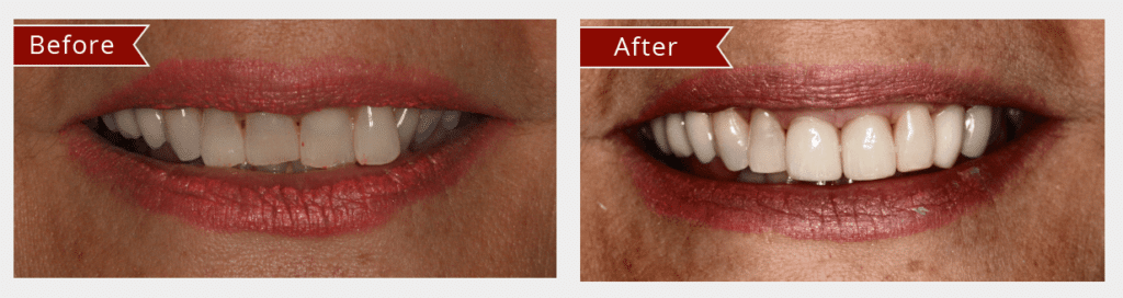 Before and After Image: Veneers - front