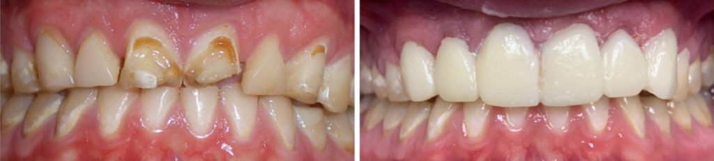Before and After Image: Crowns - front