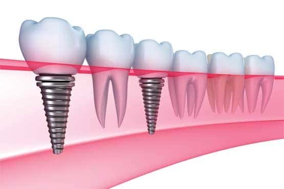 Dental-Implants-Fairfield-County-1