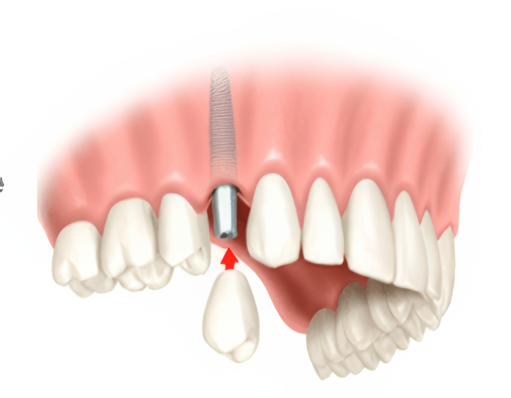 Dental-Implants-Sherman-1-topaz-upscale-4x