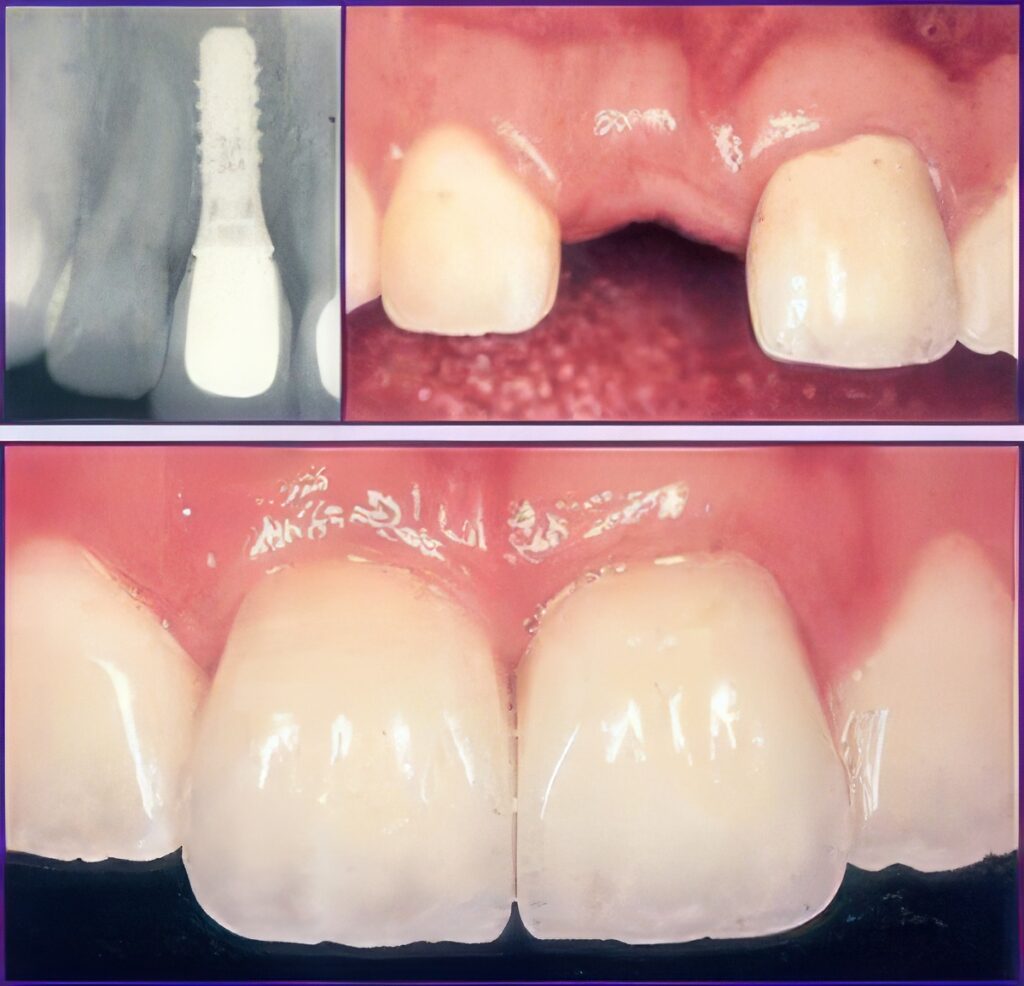 Dental-Implants-Sherman-2-topaz-upscale-4x