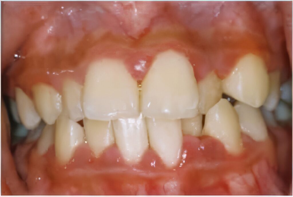 Gum-Disease-Fairfield-County-2-topaz-upscale-4x