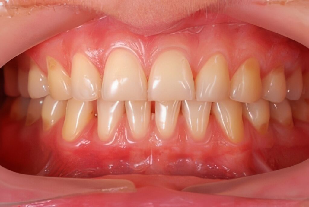 Gum-Disease-New-Fairfield-2-topaz-upscale-4x