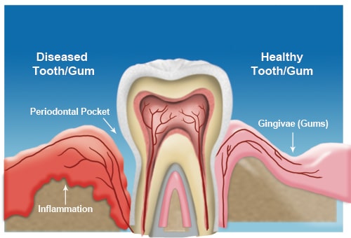 Gum-Disease-Sherman-1