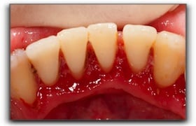 Gum-Disease-Sherman-2