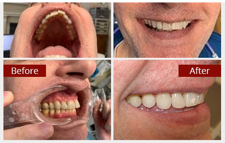 Before and After Image: SureSmile - other