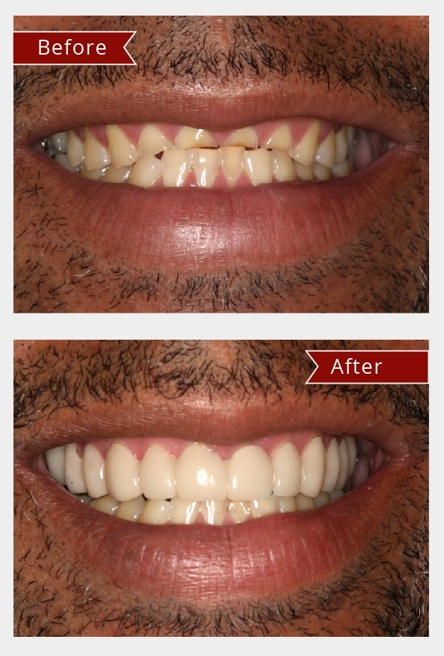 Before and After Image: Snap On Smile - front