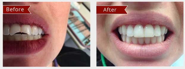 Before and After Image: Veneers - front
