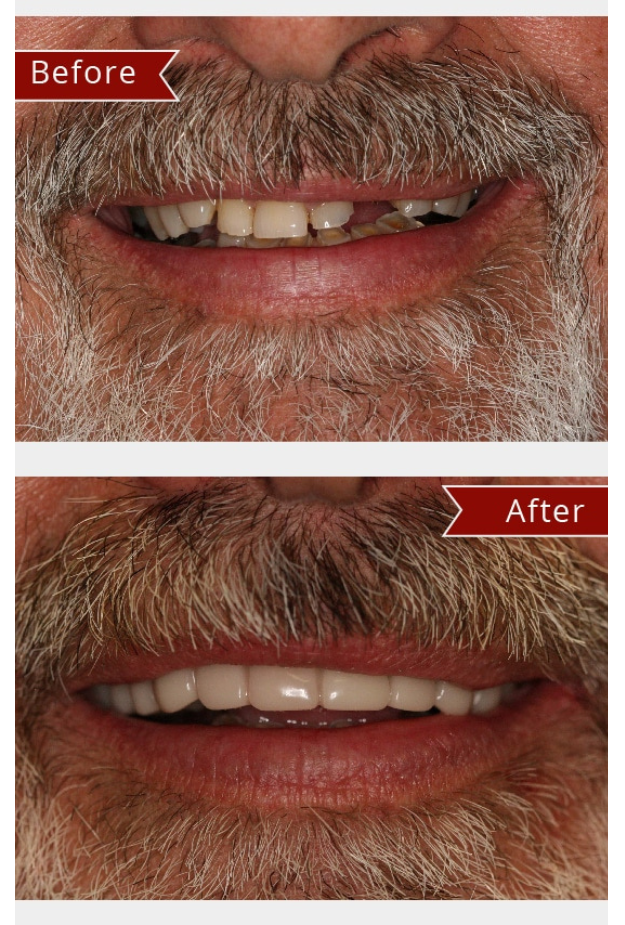 Snap on Smile Example