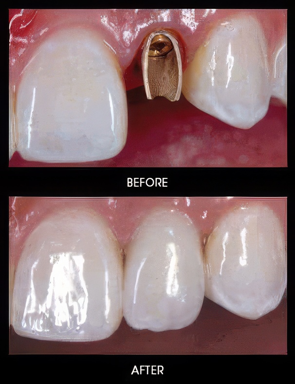 Veneers-Sherman-1-topaz-text-upscale-2x