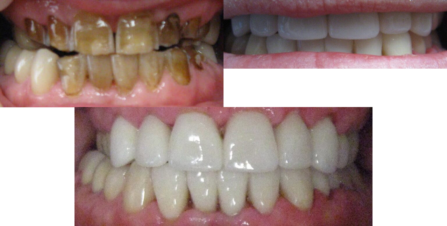 Before and After Image: Veneers - front