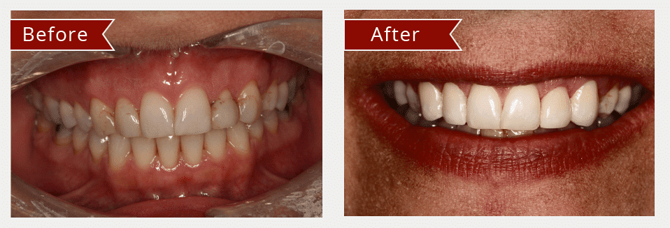 Before and After Image: Veneers - front