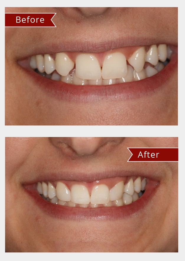 Before and After Image: Bonding - front