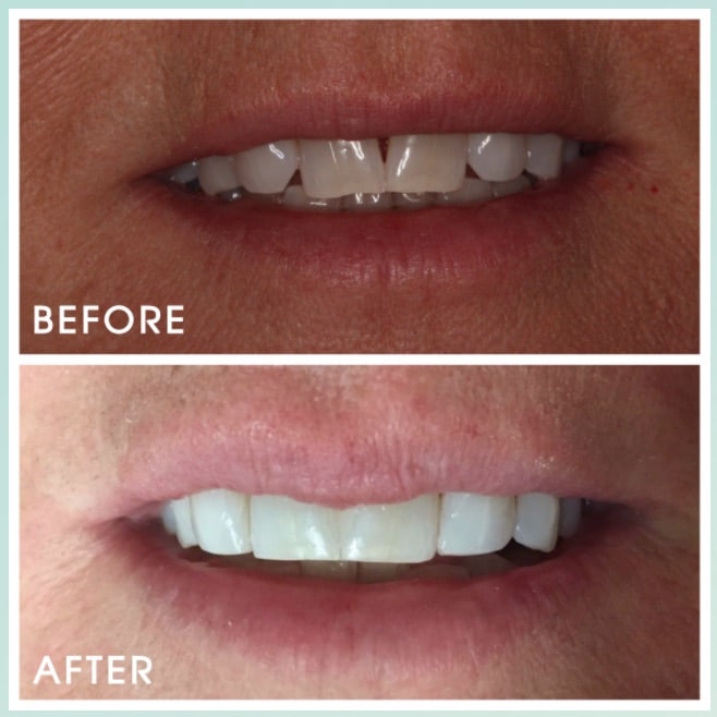 Before and After Image: Bonded Diastemas - front