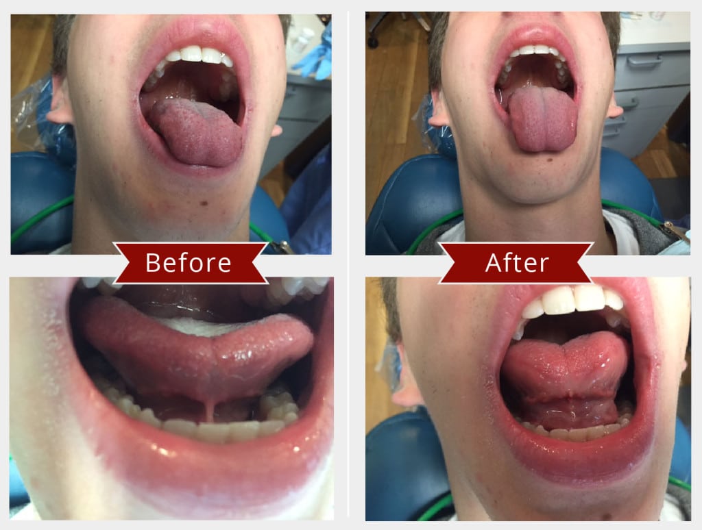 Before and After Image: Frenectomy - front