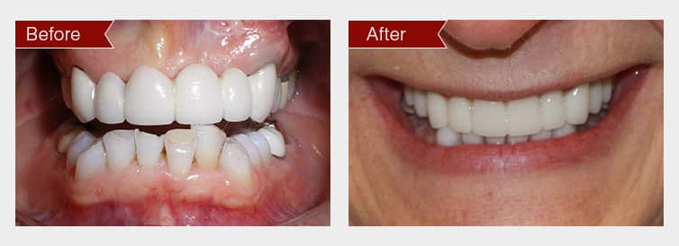 Before and After Image: Lumineers - front